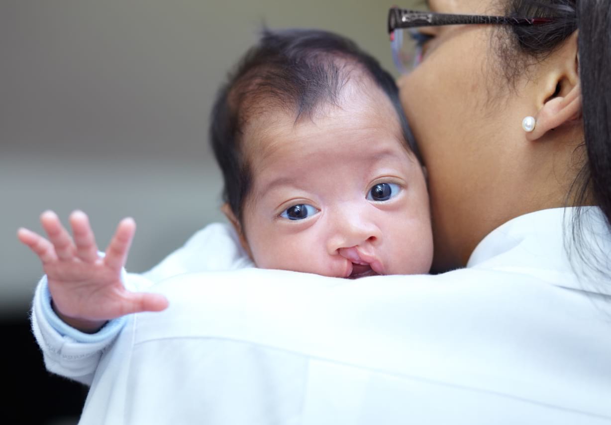 Penyebab Bibir Sumbing  Pada Bayi  Dari Lahir  Cegah Dari 